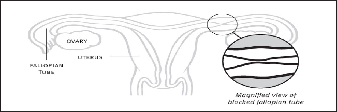 Tubal Surgery or IVF?