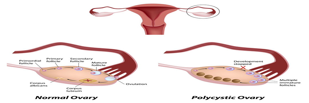 Common Fertility Treatment Protocols for PCOS