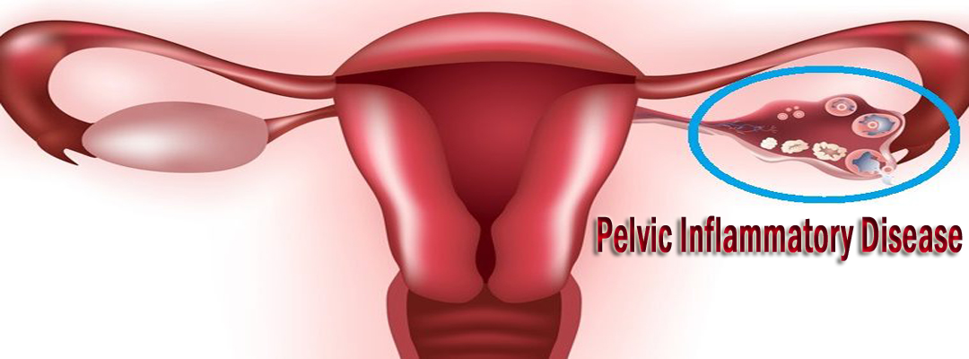 What is Pelvic Inflammatory Disease and how to Overcome it?